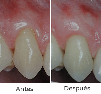 periodontal3